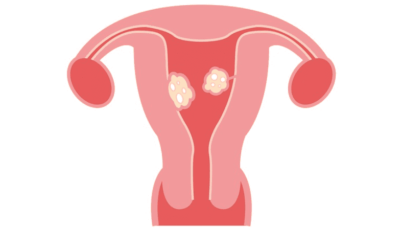 Uterine Fibroid And Infertility | Causes, Symptoms & Treatments