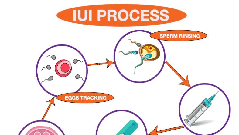 IUI Treatment: What Exactly is IUI?